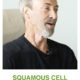 Nicks Story squamous cell carcinoma